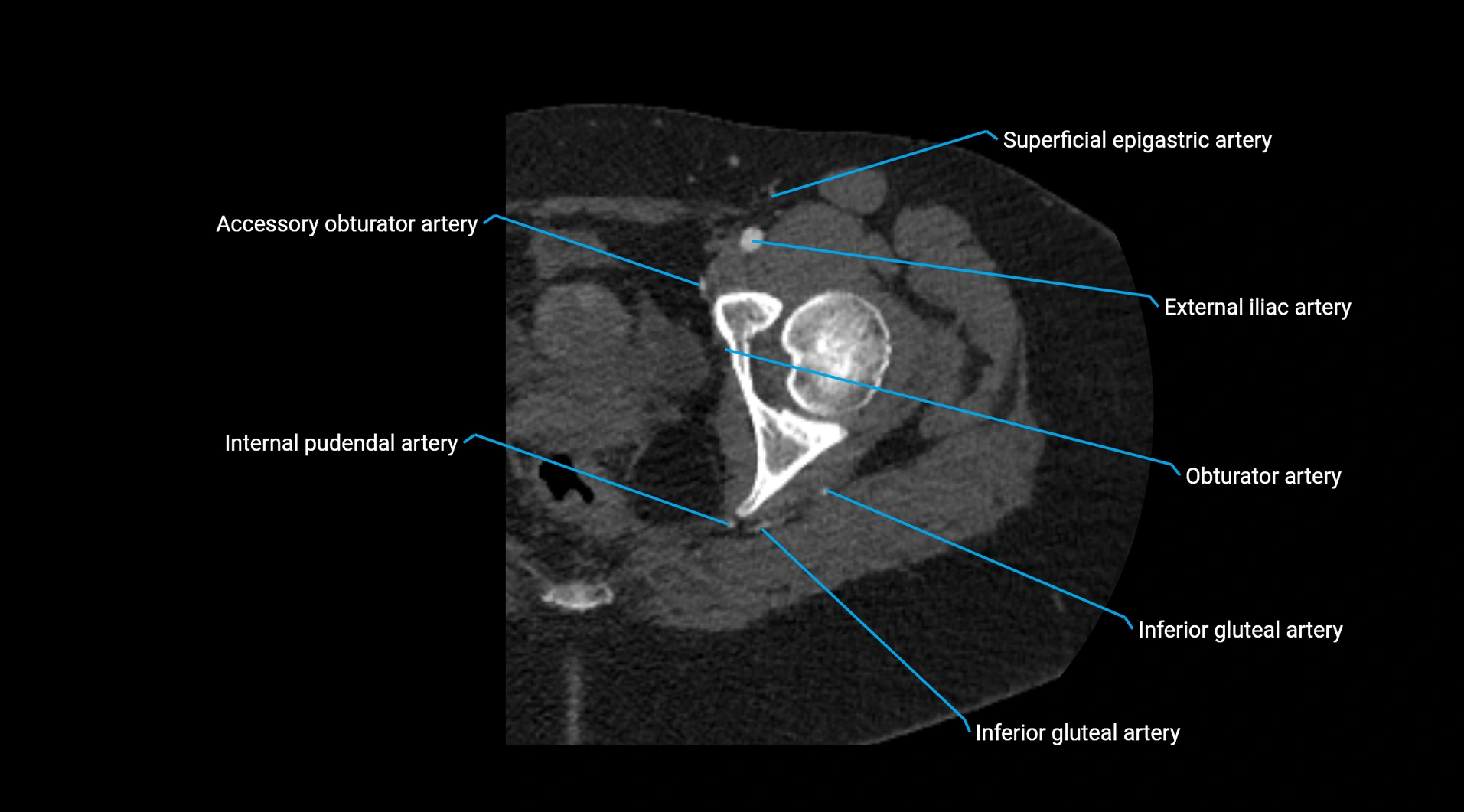 CTA lower limb cross sectional anatomy labelled image _55.webp